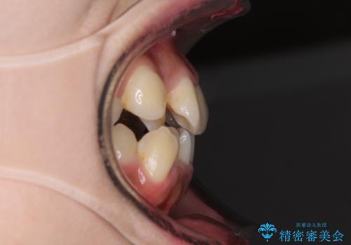 口元をスッキリと ワイヤーでの抜歯矯正の治療前