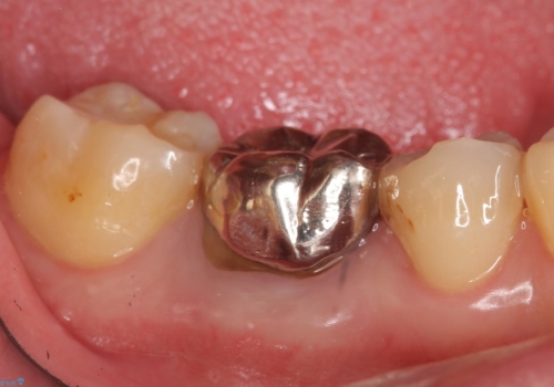 オールセラミッククラウン 鈍い痛みが続く奥歯の治療の治療前