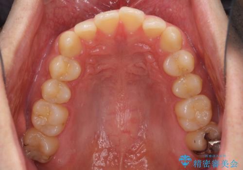 前歯の咬み合わせとデコボコを解消 インビザラインによる矯正治療の治療前