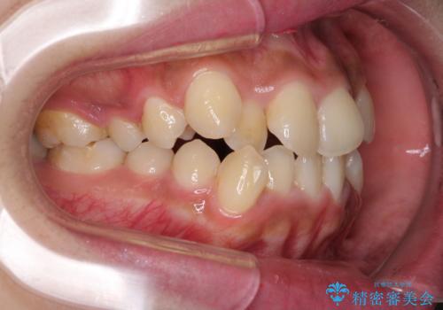 口元をスッキリと ワイヤーでの抜歯矯正の治療前