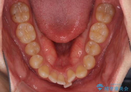 前歯の咬み合わせとデコボコを解消 インビザラインによる矯正治療の治療前