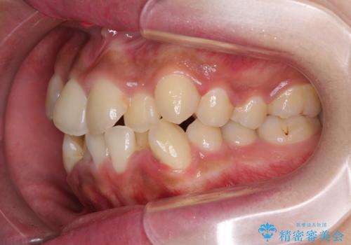 口元をスッキリと ワイヤーでの抜歯矯正の治療前