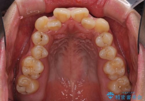 口元をスッキリと ワイヤーでの抜歯矯正の治療前