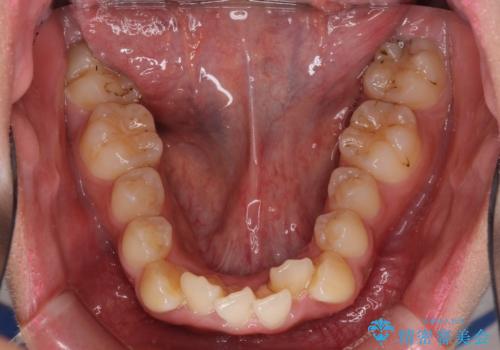 口元をスッキリと ワイヤーでの抜歯矯正の治療前