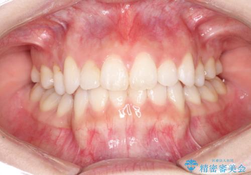 前歯の後戻りを部分矯正で整った歯並びへの症例 治療後