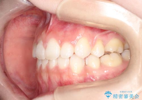 前歯の後戻りを部分矯正で整った歯並びへの治療後