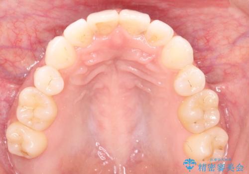 前歯の後戻りを部分矯正で整った歯並びへの治療後
