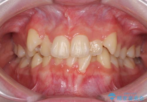 前歯をきれいに整えたい　ワイヤー装置での非抜歯矯正の症例 治療前