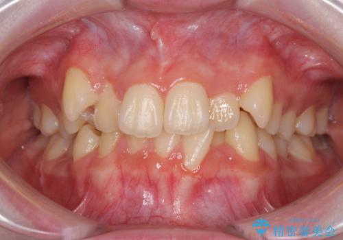 前歯をきれいに整えたい ワイヤー装置での非抜歯矯正の治療前