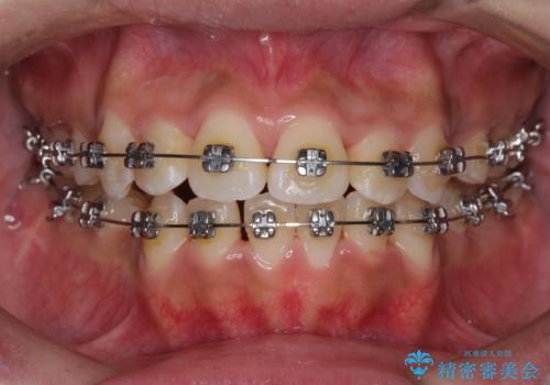 口元をスッキリと ワイヤーでの抜歯矯正の治療中