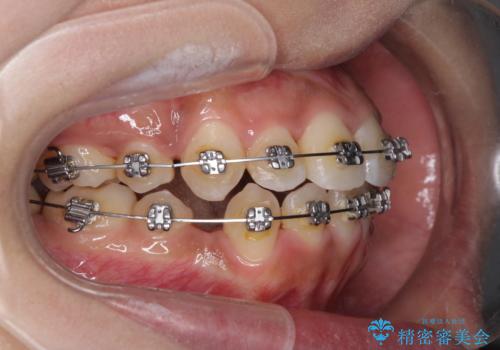 口元をスッキリと ワイヤーでの抜歯矯正の治療中
