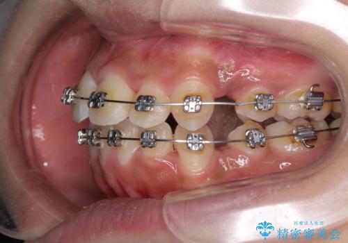 口元をスッキリと ワイヤーでの抜歯矯正の治療中