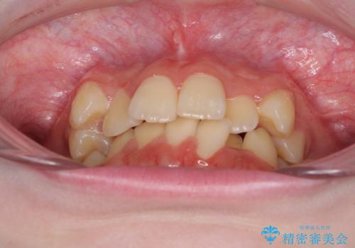 前歯をきれいに整えたい ワイヤー装置での非抜歯矯正の治療前