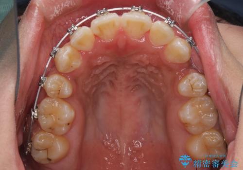 口元をスッキリと ワイヤーでの抜歯矯正の治療中