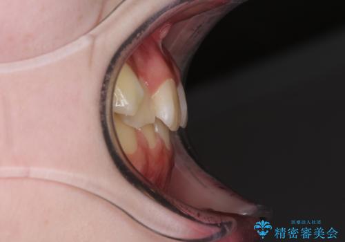 前歯をきれいに整えたい ワイヤー装置での非抜歯矯正の治療前