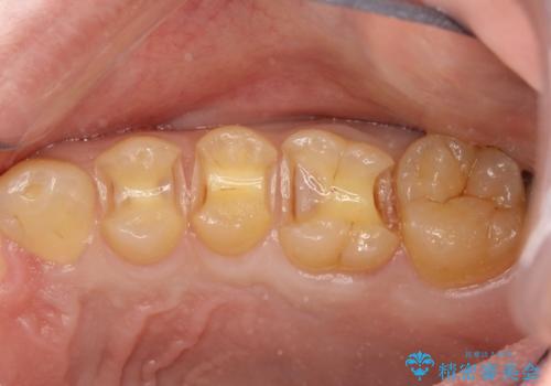 虫歯を治したい、セラミックによる治療の治療中