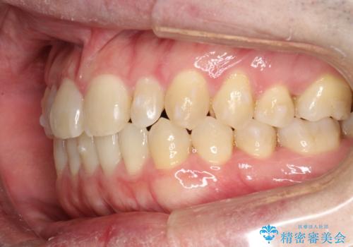 前歯の隙間　インビザラインにて整った歯並びへの治療中