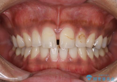 歯の着色落としの症例 治療前