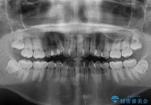 口元をスッキリと ワイヤーでの抜歯矯正の治療前