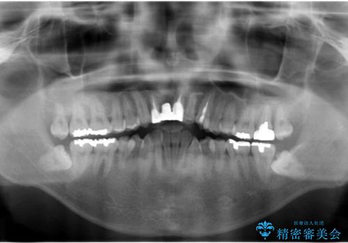 前歯ブリッジのやりかえ 下の歯のがたつき 銀歯を全てセラミックにの治療前