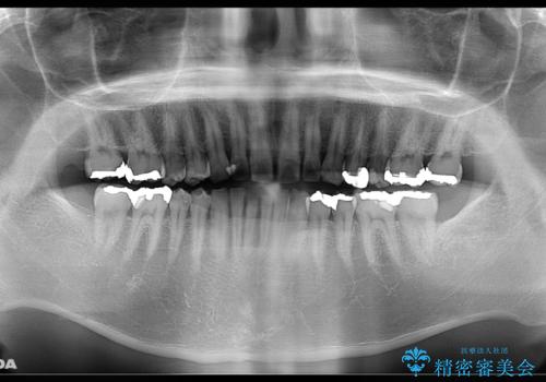 歯の着色落としの治療前