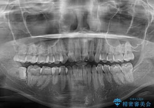 前歯のデコボコと突出感 インビザラインで改善の治療前