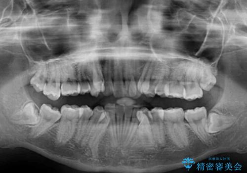 気になる八重歯を治したい ワイヤー装置での抜歯矯正の治療前