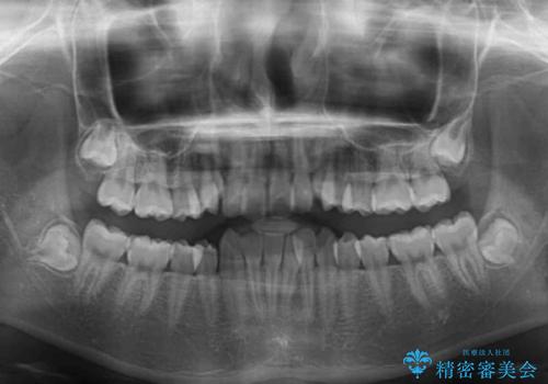 前歯をきれいに整えたい ワイヤー装置での非抜歯矯正の治療前