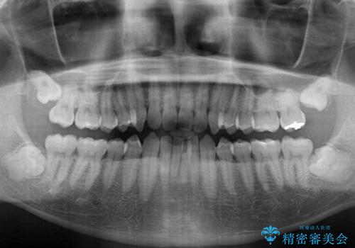 前歯の咬み合わせとデコボコを解消 インビザラインによる矯正治療の治療前