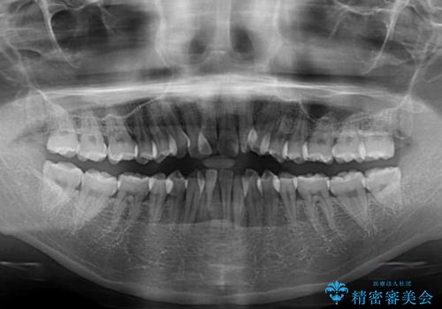 前歯のデコボコを治したい 費用を抑えた抜歯矯正の治療前