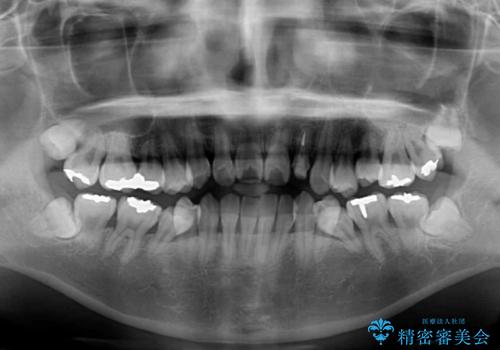 話しにくい歯並びの改善 抜歯矯正治療と前歯の審美治療の治療前
