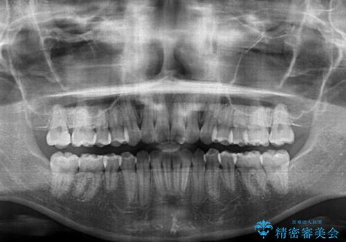 前歯のデコボコと突出感 インビザラインで改善の治療後