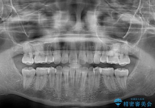 気になる八重歯を治したい ワイヤー装置での抜歯矯正の治療後