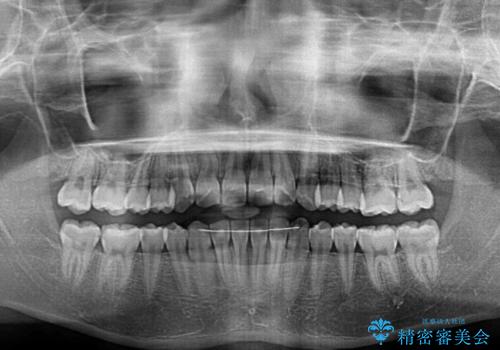 前歯をきれいに整えたい ワイヤー装置での非抜歯矯正の治療後