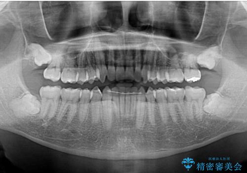 前歯の咬み合わせとデコボコを解消 インビザラインによる矯正治療の治療後