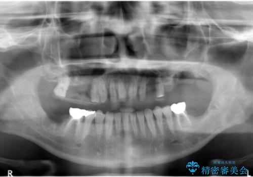 インプラントを用いた歯周病全顎治療の治療中