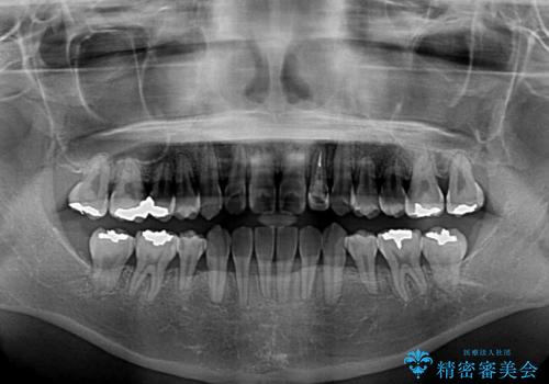 話しにくい歯並びの改善　抜歯矯正治療と前歯の審美治療の治療後
