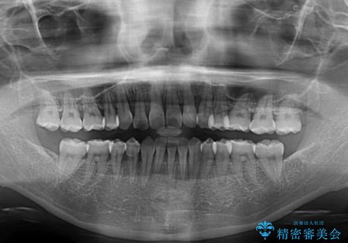 前歯のデコボコを治したい 費用を抑えた抜歯矯正の治療後