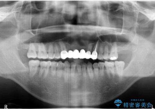 前歯ブリッジのやりかえ 下の歯のがたつき 銀歯を全てセラミックにの治療後
