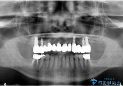 インプラントを用いた歯周病全顎治療の治療後