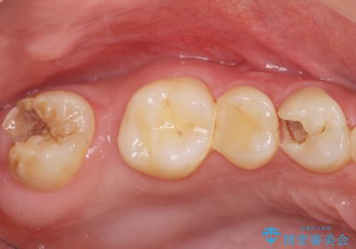 インプラントを用いた臼歯部欠損補綴の治療前