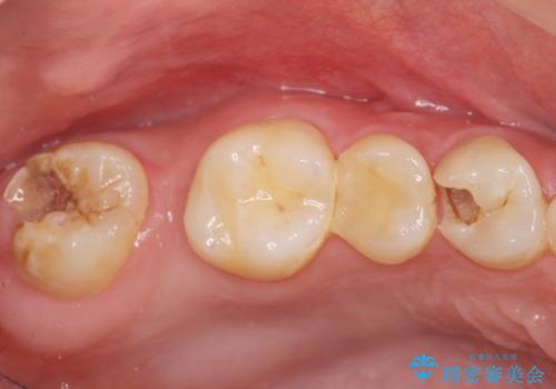 インプラントを用いた臼歯部欠損補綴の症例 治療前