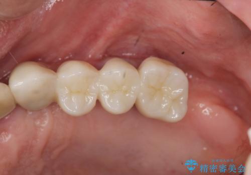 [入れ歯にしたくない] 臼歯部インプラント補綴の治療後