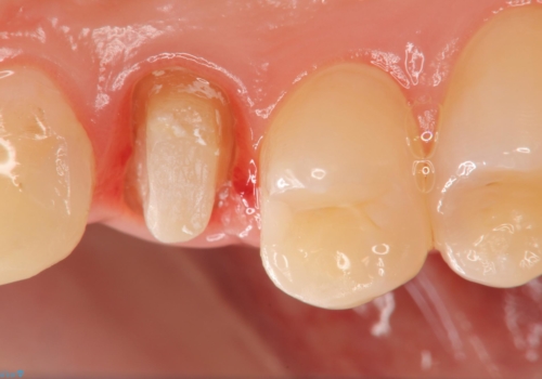 虫歯で歯が折れた セラミック審美修復の治療中