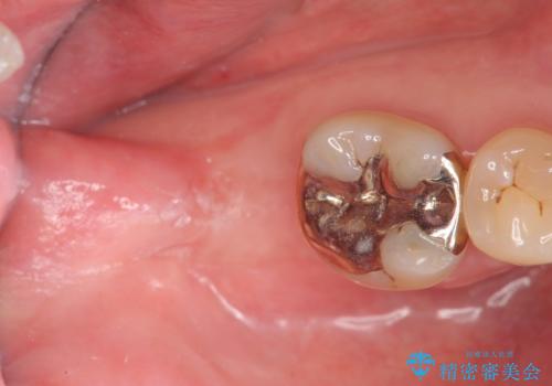 抜歯時歯槽堤保存術を用いた骨造成・インプラント治療の治療中