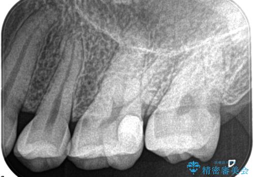 奥歯が痛い。根管治療の治療前