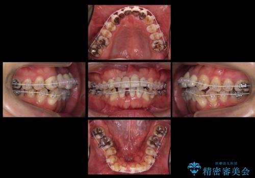 前歯ブリッジのやりかえ　下の歯のがたつき　銀歯を全てセラミックにの治療中
