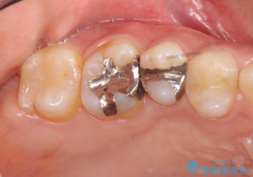 以前治療した歯が痛む　銀歯をセラミックにの症例 治療前