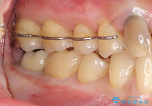 抜歯時歯槽堤保存術を用いた骨造成・インプラント治療の治療後