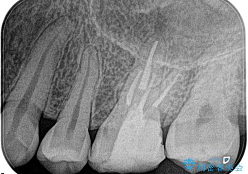 奥歯が痛い。根管治療の治療後